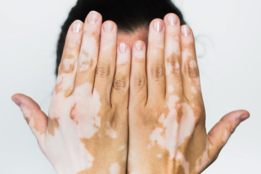 vitiligine