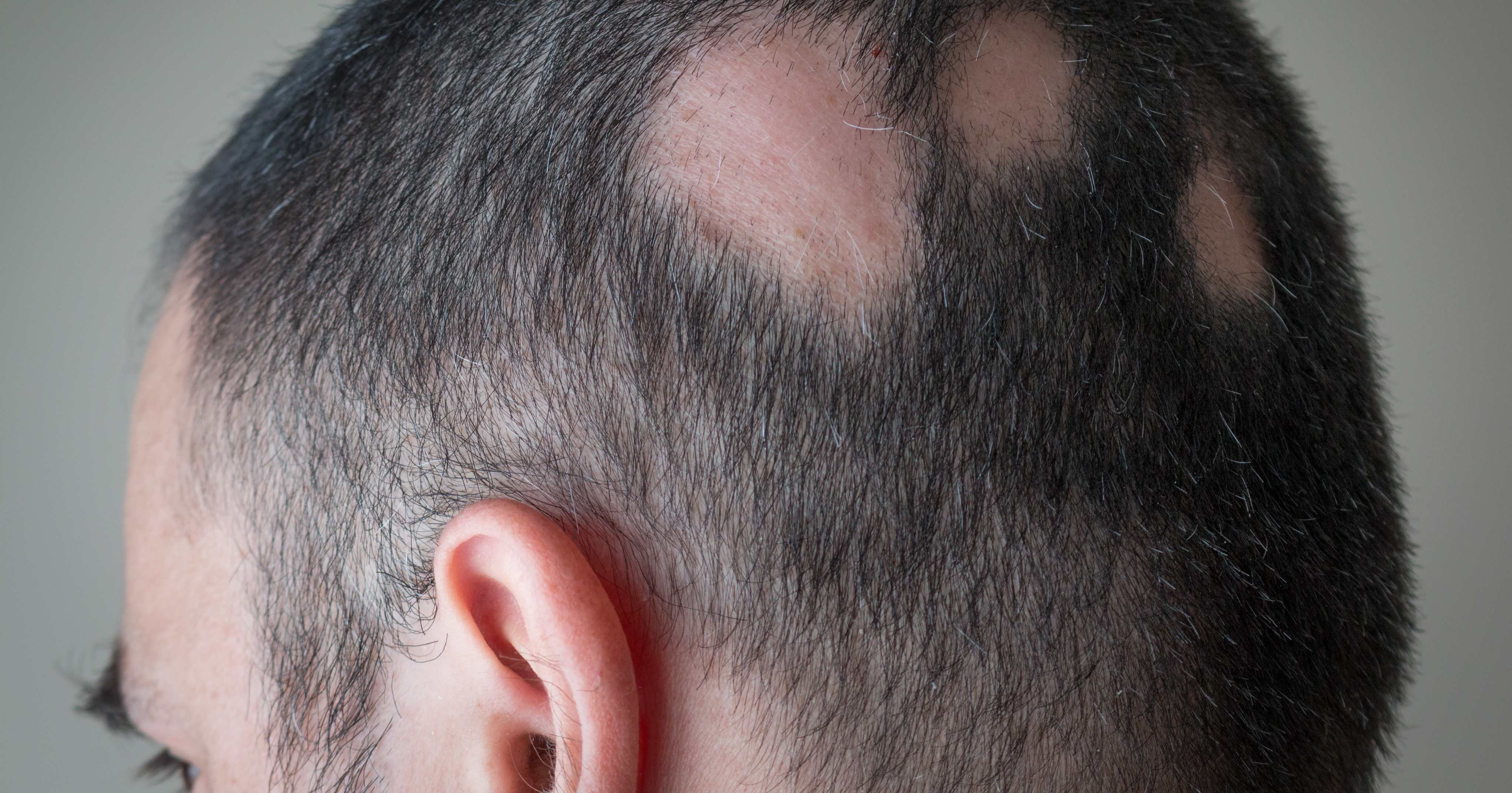 Alopecia a chiazze Alopecia a chiazze