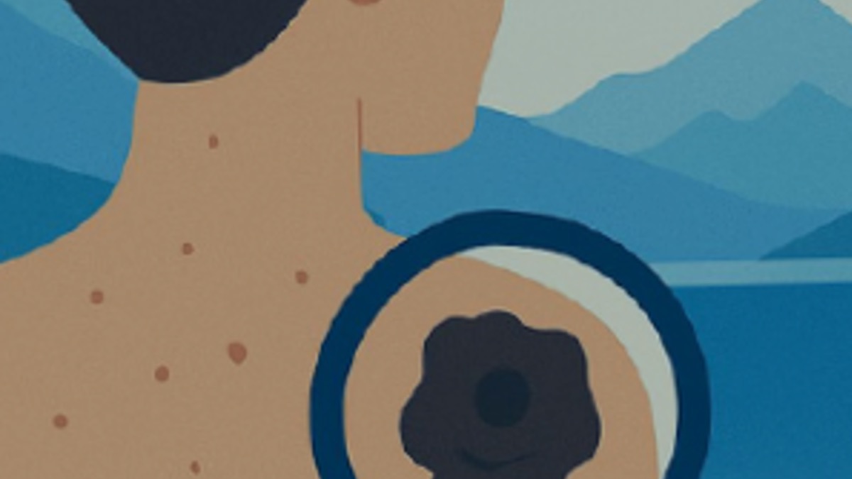 disegno di un melanoma sotto lente